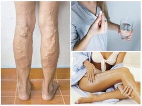 Ang mga varicose veins sa mga binti at mga pamamaraan ng paggamot