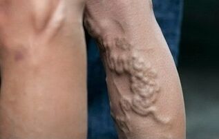Varicose veins sa mga binti
