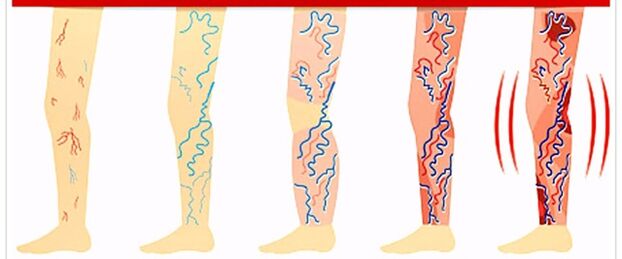 Ano ang hindi dapat gawin sa mga varicose veins