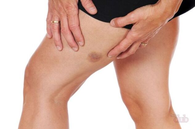 Kung sumabog ang isang ugat