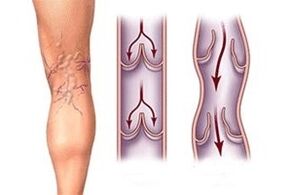 Ang pag -agos ng dugo sa mga varicose veins sa iba't ibang yugto ng pag -unlad ng sakit