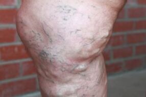 Posibleng mga komplikasyon ng mga advanced na varicose veins sa mga binti