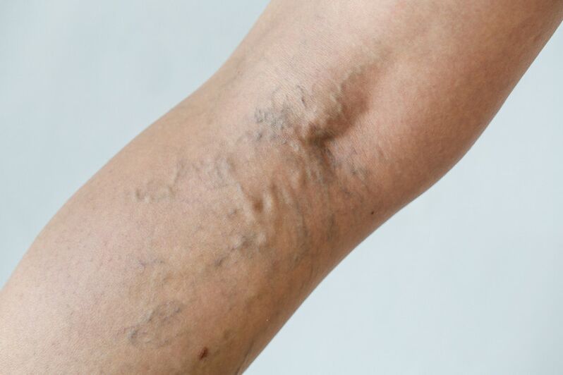 Stage C2 - popliteal varicose veins (Thierry perforator) at reticular veins